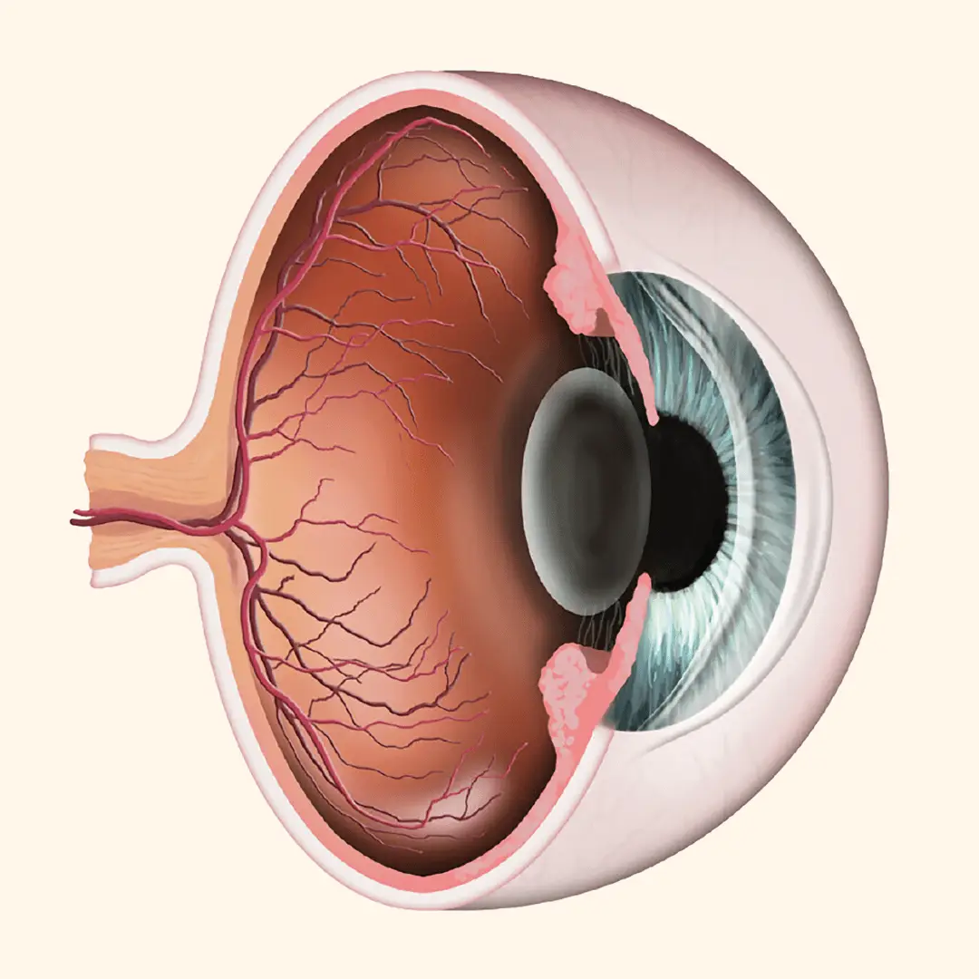 Schütt Optik Hörakustik Ludwigsburg Gefäße Auge