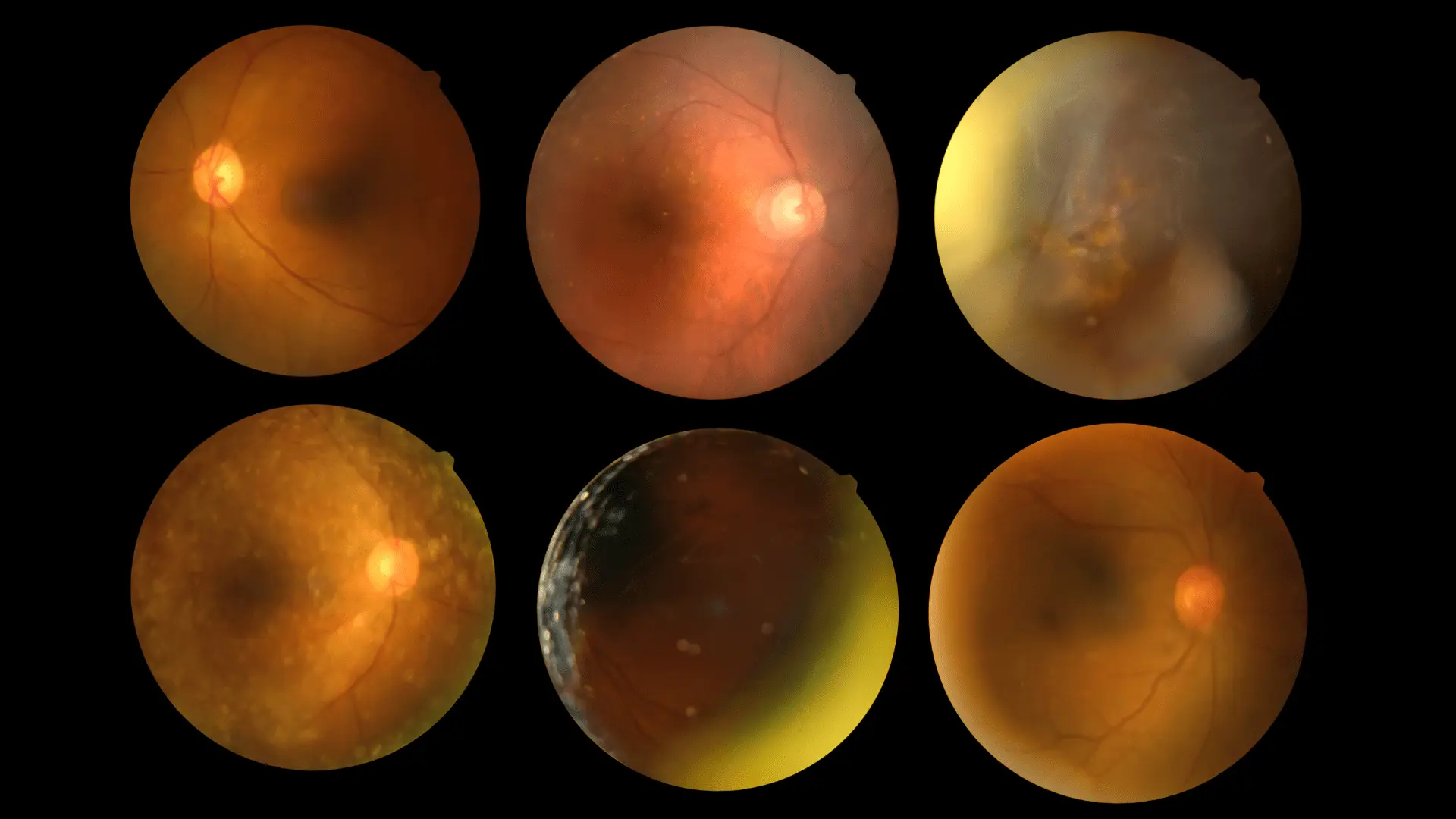 Schütt Optik Hörakustik Ludwigsburg Wissen Diabetische Retinopathie